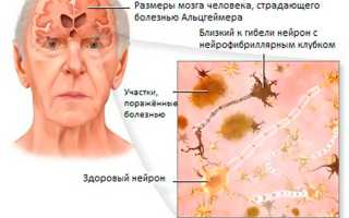 Деменция – что это такое? Деменция у пожилых людей: симптомы и лечение, прогноз