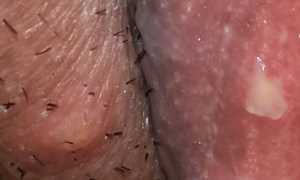 Могут ли быть язвы при молочнице на половых органах