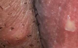 Могут ли быть язвы при молочнице на половых органах