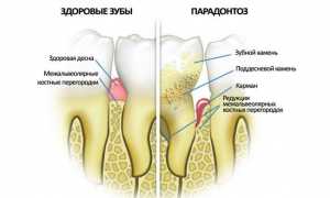Страдаете от пародонтоза? Узнайте, как вернуть здоровую улыбку