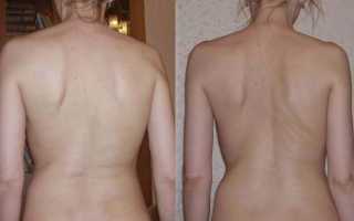 Как проявляется сколиоз 2 степени? Симптомы, лечение, профилактика