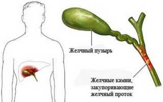 Калькулезный холецистит: что это такое и как его распознать