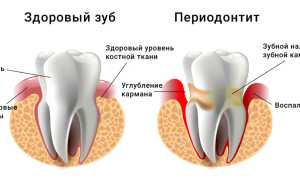 Что такое периодонтит — причины, симптомы и методы лечения