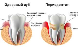 Что такое периодонтит — причины, симптомы и методы лечения