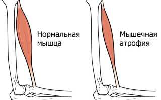 Атрофия