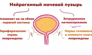 Нейрогенный мочевой пузырь