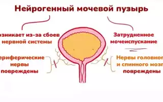 Нейрогенный мочевой пузырь
