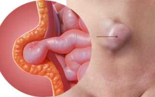 Пупочная грыжа у взрослых — причины, признаки и способы устранения