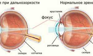 Контактные линзы при дальнозоркости и пресбиопии