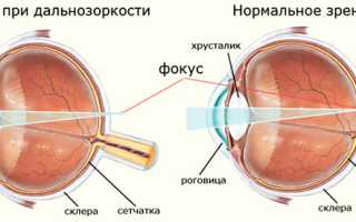 Контактные линзы при дальнозоркости и пресбиопии