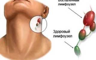 Увеличение лимфатических узлов