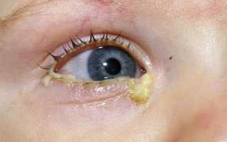 Конъюнктивит у грудничка