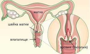 Чем опасна эрозия шейки матки? Симптомы, диагностика и методы лечения
