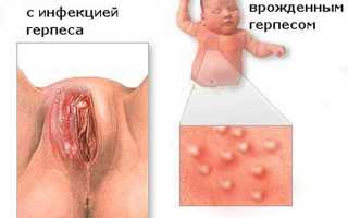 Герпес на половых губах — почему возникает и как от него избавиться?