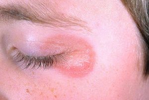 Грибок на глазах