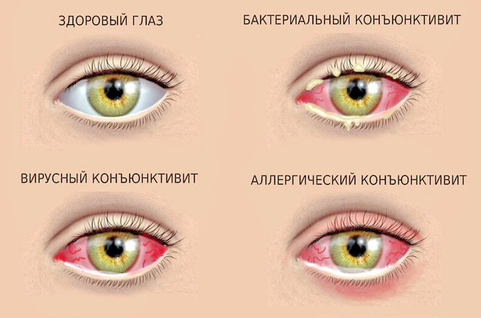 Коньюктивит