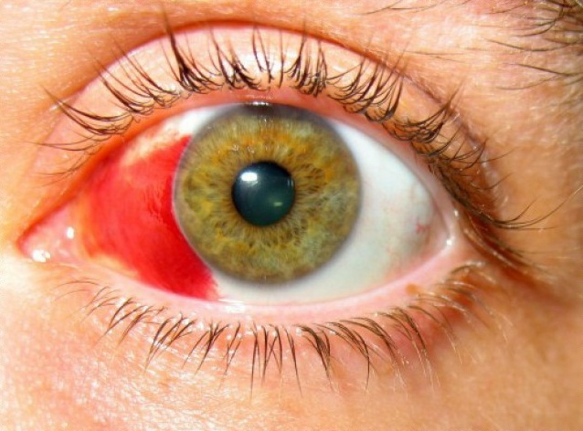 Кровоизлияние в глазу