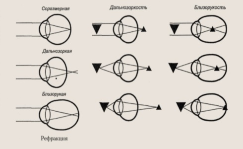 Рефракция глаза