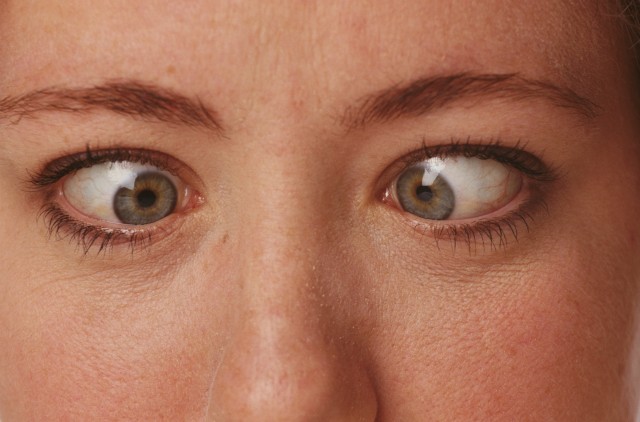 Сведение глаз к носу