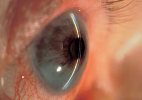 Внешняя глубокая камера глаза