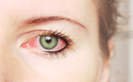 Воспаление глаз