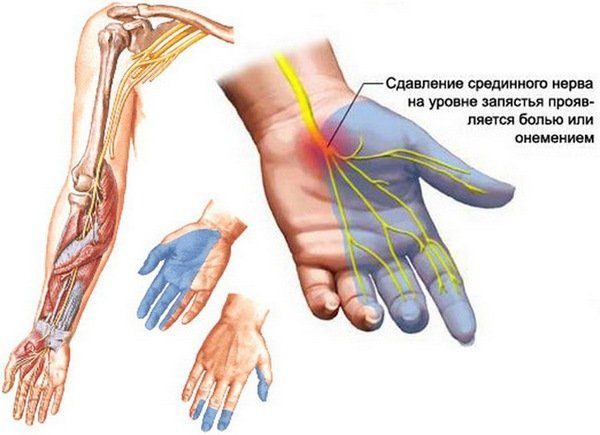 Постоянный стресс, нервное напряжение способны вызвать неприятные ощущения в правой руке