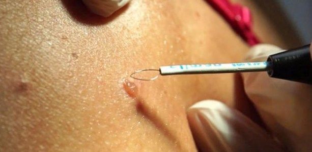 На фото показано радиоволновое удаление атеромы 1 степени.