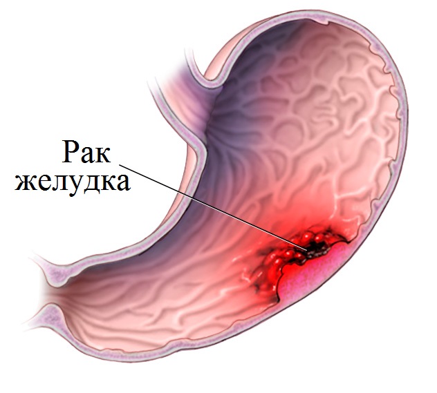 Рак желудка на ранних стадиях не имеет каких-либо высокоспецифичных признаков, его часто можно не заметить при язве желудка