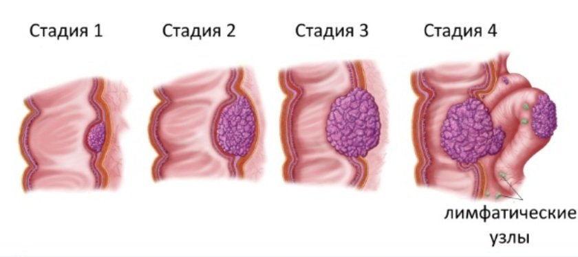 На фото стадии рака толстого кишечника - 1, 2, 3, 4 стадии онкологии.