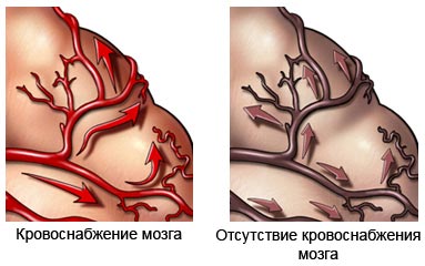 Причины и симптомы деменции. Как лечить деменцию фото