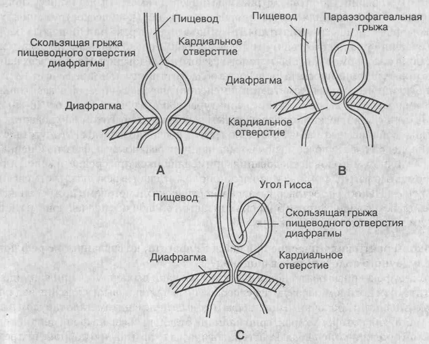 Грыжи смешанного типа делятся по размеру на 3 степени