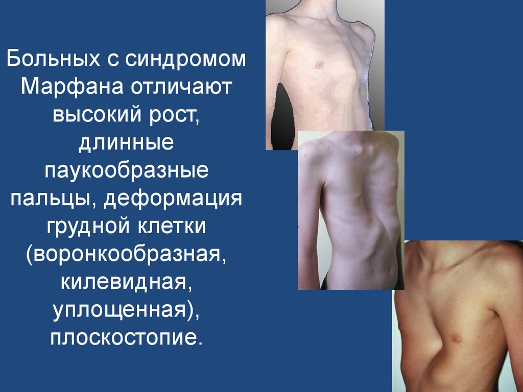 Синдром Марфана приводит к деформации грудной клетки