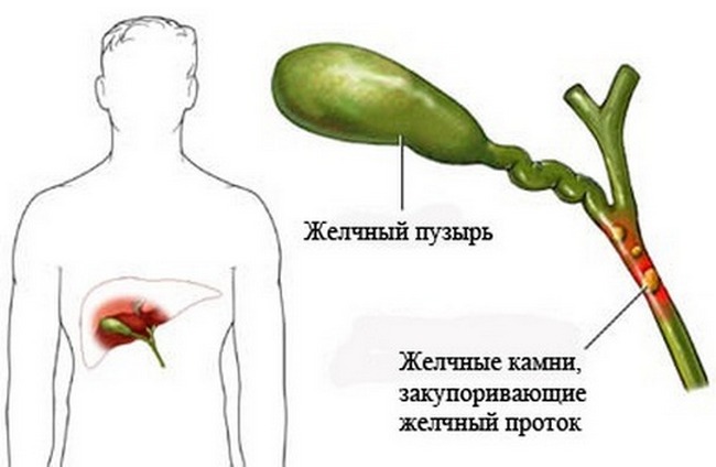 В результате заболевания поражается желчный пузырь