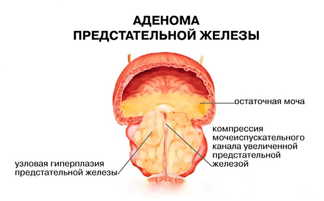 Простатилен применяется для лечения простатита и аденомы предстательной железы