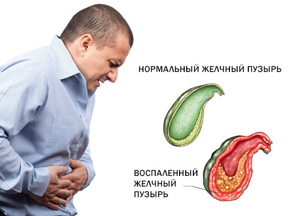 Воспаление желчного пузыря