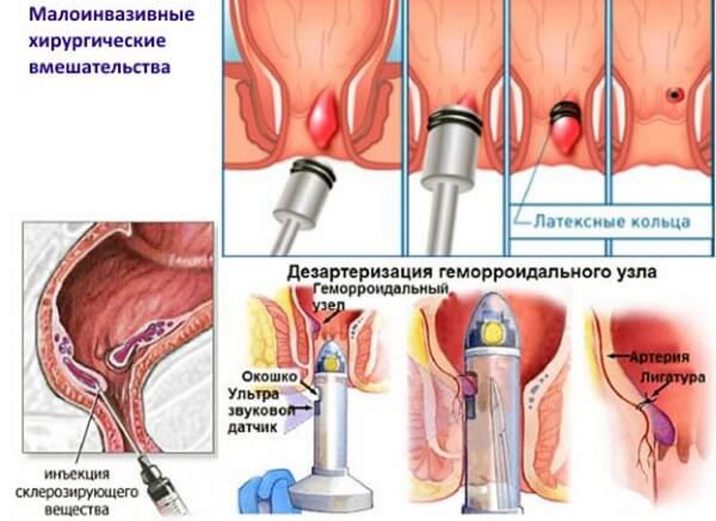 ВНЕШНИЙ ГЕМОРРОЙ - ФОТО ЛЕЧЕНИЕ. Малоинвазивное хирургическое вмешательство.