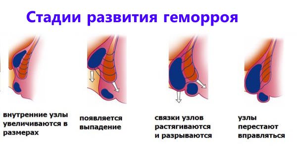 На фото показаны стадии развития геморроя.