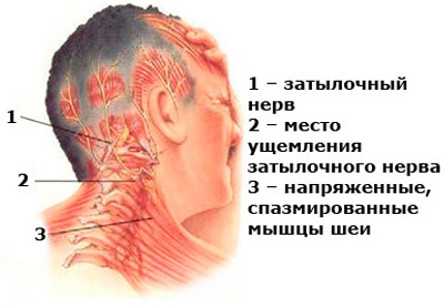 Затылочная невралгия является частой причиной головной боли