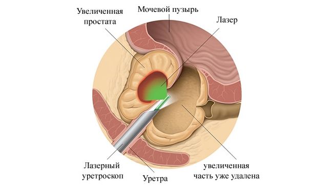 Устранение аденомы простаты