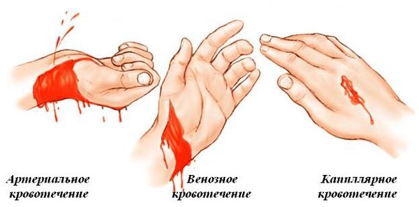 Виды кровотечений