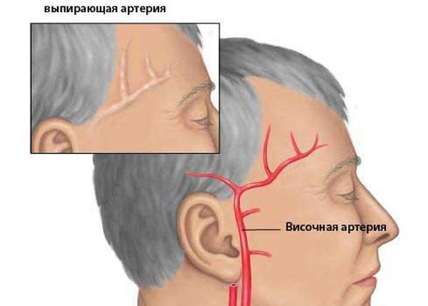Височная артерия
