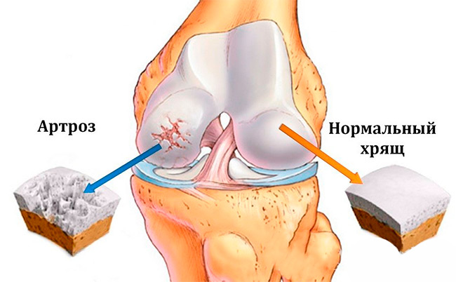 Женщины, а также лица старше 40 лет наиболее подвержены возникновению артроза коленного сустава