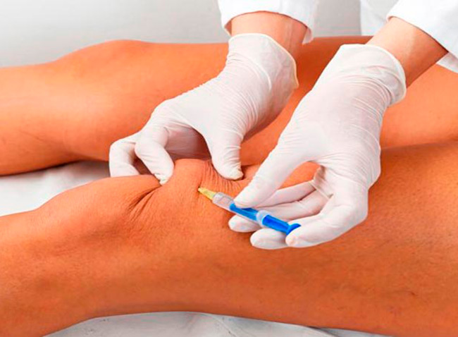 Для устранения болевых ощущений и снятия воспаления применяются нестероидные противовоспалительные средства, которые наиболее эффективны в виде инъекций в суставную ткань