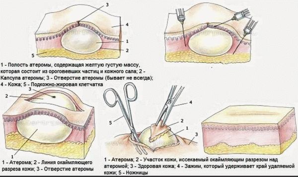 Атерома на голове: этапы удаления новообразования хирургическим путем.