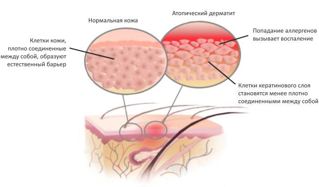 Атопический дерматит у детей – хроническое аллергическое заболевание кожных покровов, которое развивается у детей с генетической предрасположенностью к атопии