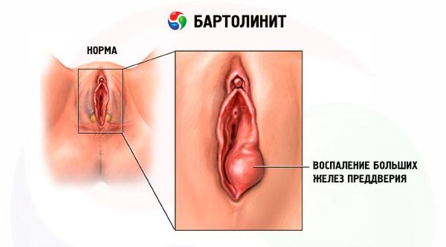 На фото показано заболевание бартолинит
