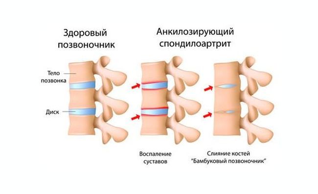 Болезнь Бехтерева поражает осевой скелет и крестец
