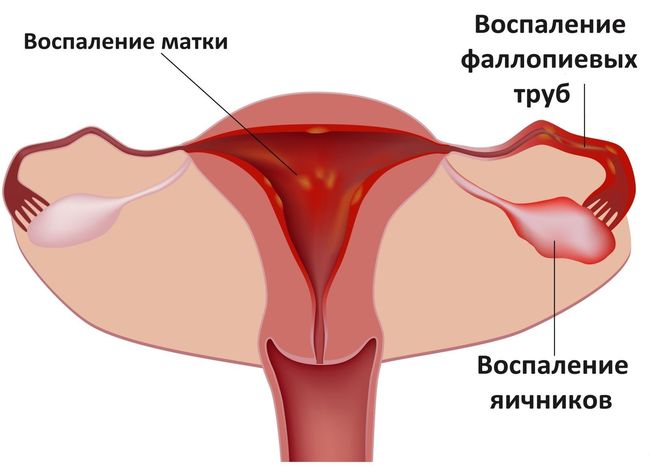 Болезненные ощущения в этой части живота у женщин могут возникнуть из-за проблем в области гинекологии
