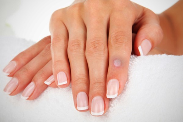 Опасность бородавок кроется не столько в косметической проблеме кожи, сколько в возможности возникновения вируса папилломы человека