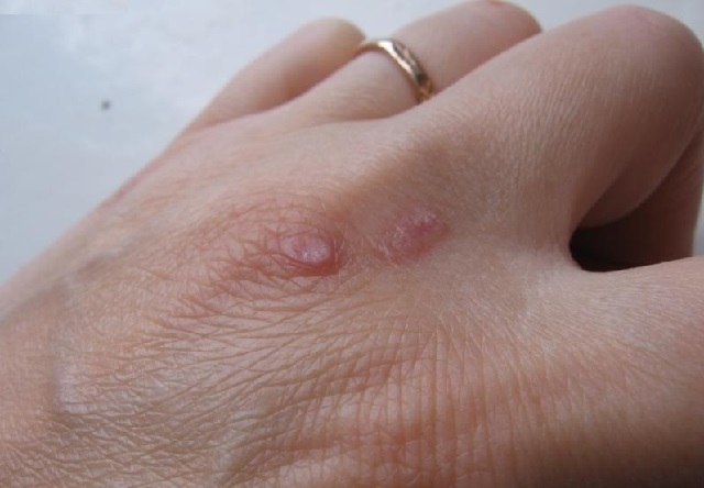 При возникновении бородавок, особенно в обильном количестве, следует незамедлительно посетить дерматолога